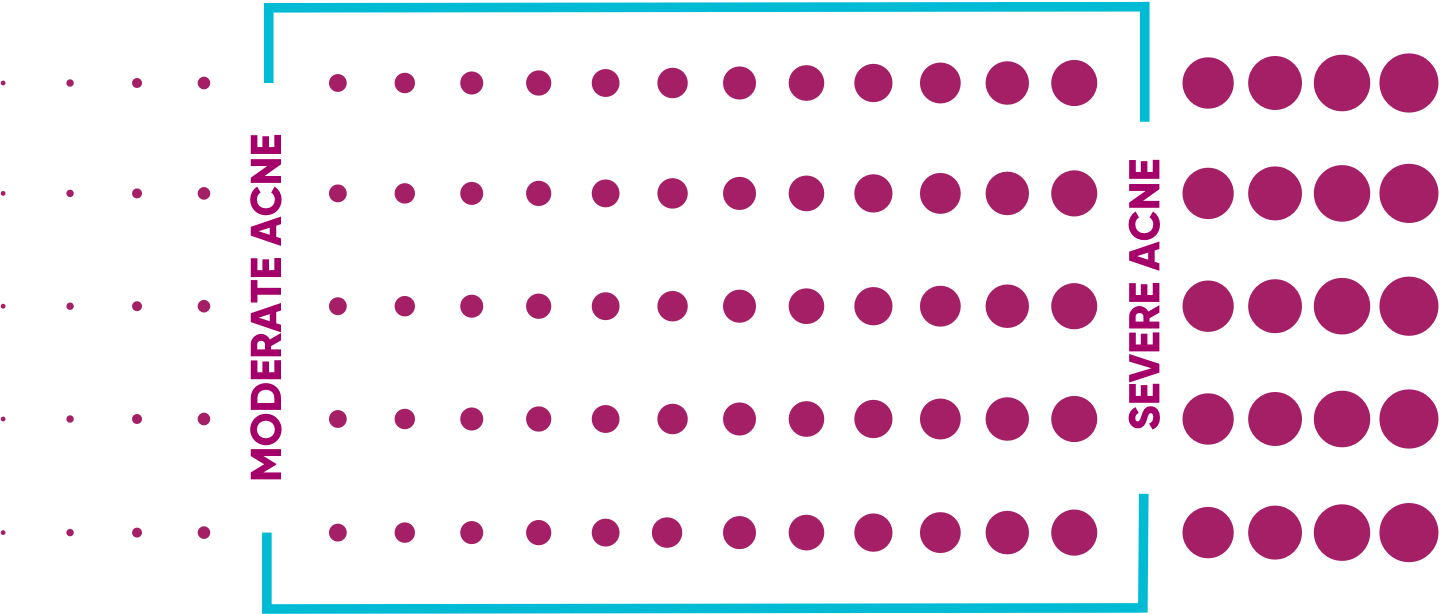 moderate to severe acne